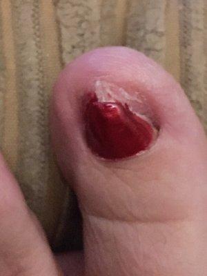 This is what the other toenail looks like after her butcher job!