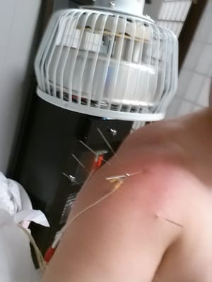 My Shoulder getting Electrical Acupuncture and heating lamp.