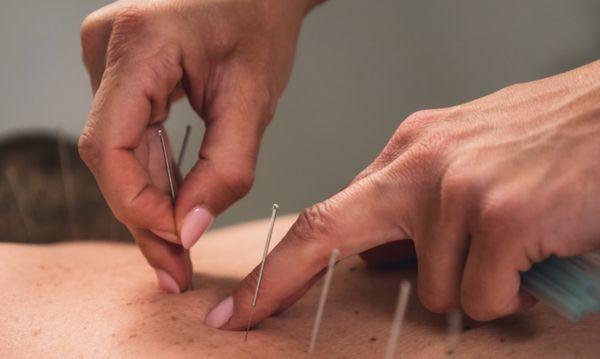 Acupuncture Treatments 
Call Today to Schedule (516) 783-1454