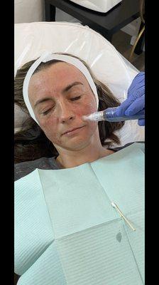 Microneedling