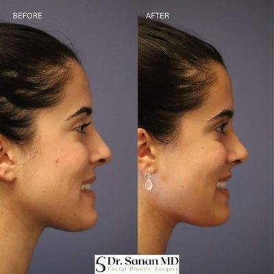 Female Rhinoplasty