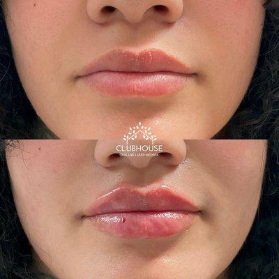 LIP FILLER