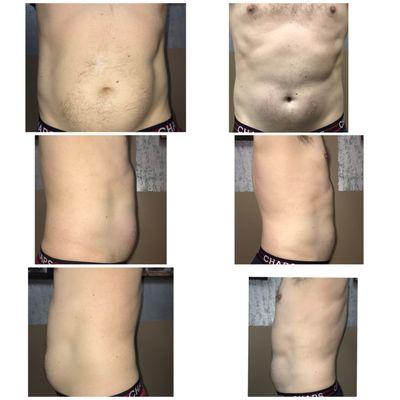 48 year old male. Eight cavitation sessions. Do diet or exercise change beyond what was recommended.