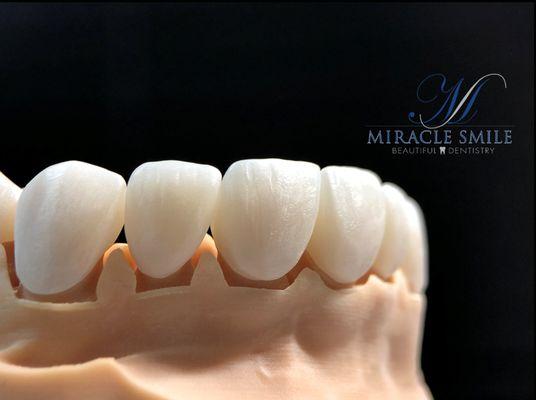 Porcelain Crowns -esthetic and function