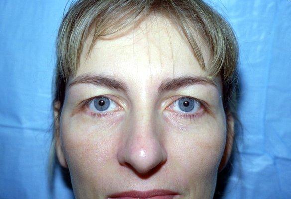 Pre upper eyelid blepharoplasty (eyelid tuck)