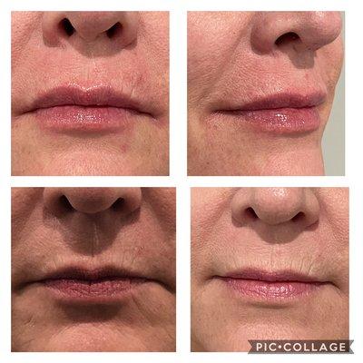 Lip and Marionettes Filler