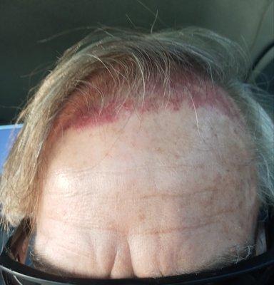 Damaged hair line and scalp