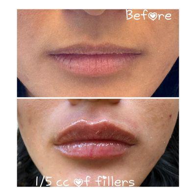 Natural lip fillers