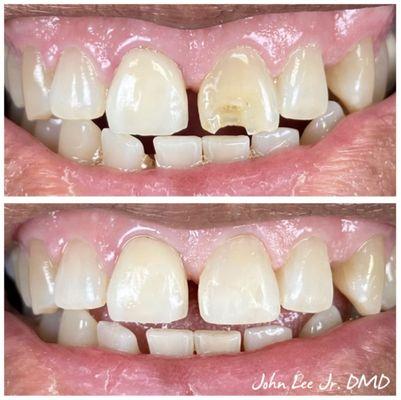 Direct Composite Veneer was done to fix a chipped tooth and brighten the shade. Single appointment, no shots or drilling needed!