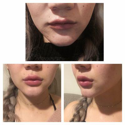 Before and after 1 full syringe. #dollylips