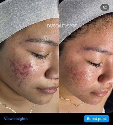 Client's results 3 facials apart