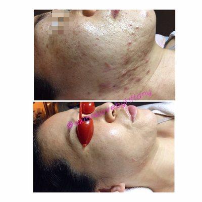 Face reality acne treatment