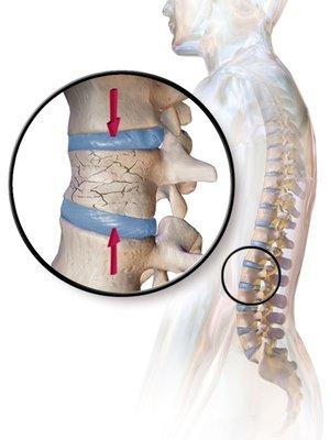 Compression Fractures