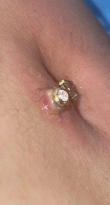 Infected belly button piercing