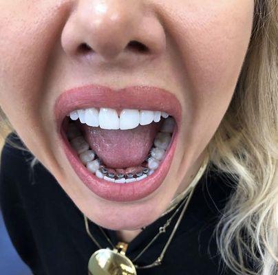 Want to keep your braces a secret? No problem!