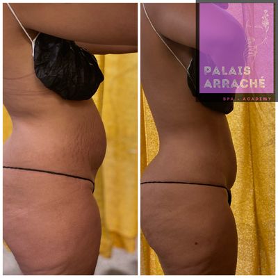 One Tummy Tuck Session for $165, 8 sessions for $800