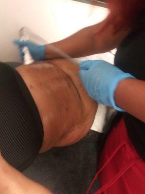 Cavitation lipo (liquifying fat)