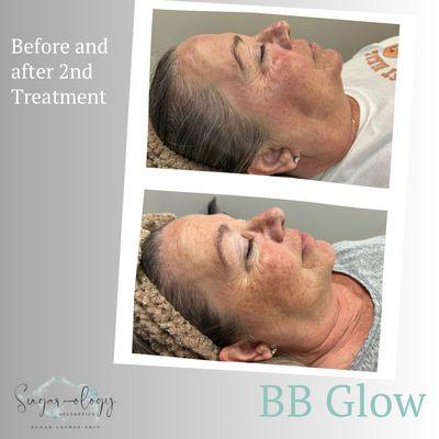 BB Glow treatment 2 of 3. Evens out the skin tone, reduces fine lines and wrinkles.