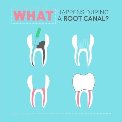 Endodontic therapy simplified...