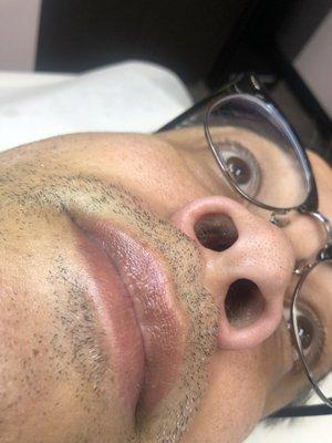 Side-by-side nostrils before and after.