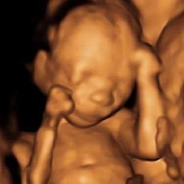 3D ultrasounds