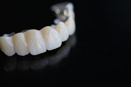 A bridge replaces missing teeth with a cast tooth that looks great, literally "bridging the gap" where one or more teeth once were.