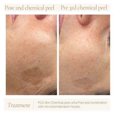 Pca skincare chemical peel journey