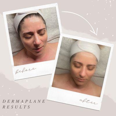 Before and after dermaplane facial