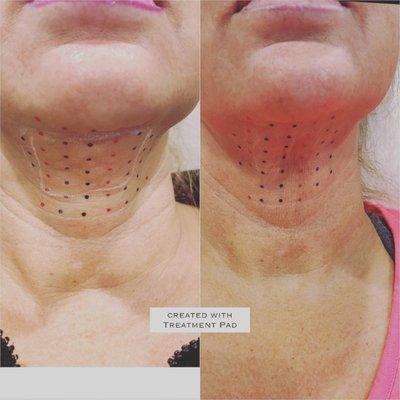 Skin tightening to reduce double chins