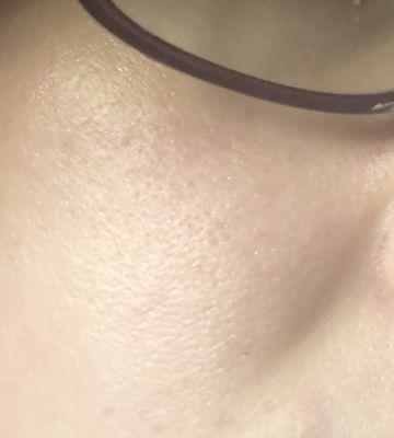 Damage from chemical peel on my cheeks. Pores MAJORLY enlarged. 7 months post.