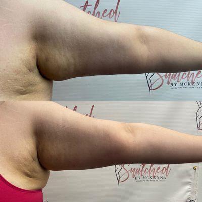 Lipo cavitation One Session on Arms