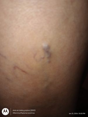 Varicose  vein / CVI