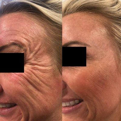 Botox in the crows feet is great for smoothing out lines!