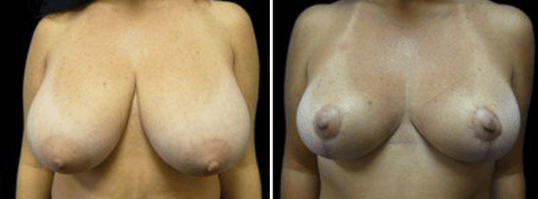 Breast Reduction/Lift Before & After