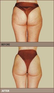 We offer Endomology Cellulite Treatment drasticly reducing cellulite and inches where you want it most.