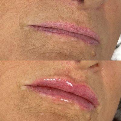 Before and after lip filler's at Laria's MedSpa.