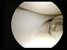 Arthroscopic Surgery