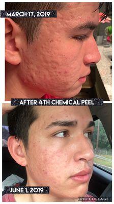 Chemical peel on 18 year old with sever cystic acne. He needs at least 2 more.