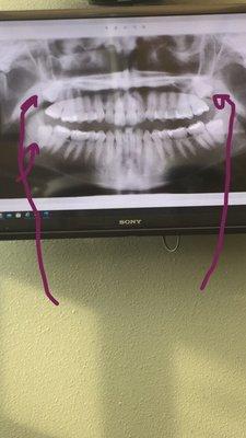 Drew arrows to the harder to see wisdom teeth. There are 4. I don't imagine the upper ones were easy to get out!