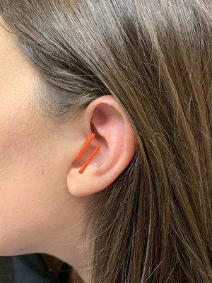 Auricular Acupuncture Treatment