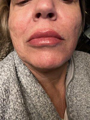 Another after lip fillers