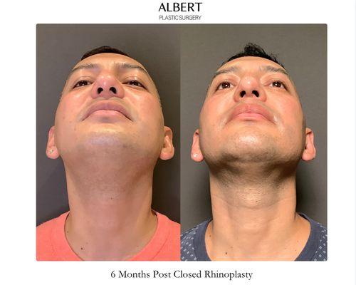 Closed (Scarless) Rhinoplasty