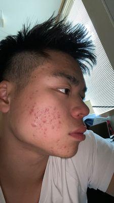 before treatment (lots of inflammation, cystic acne, redness)