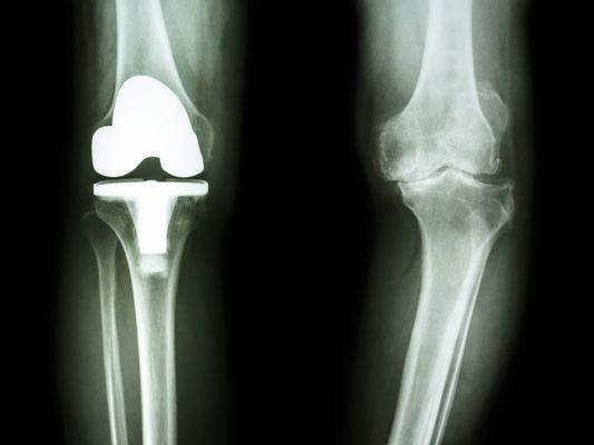 Total Knee Replacement.