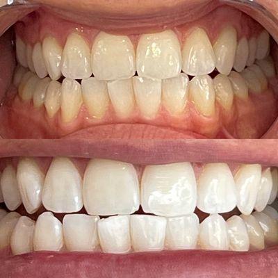 60 Minute Teeth Whitening Session