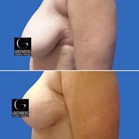 Breast Lift Before & After