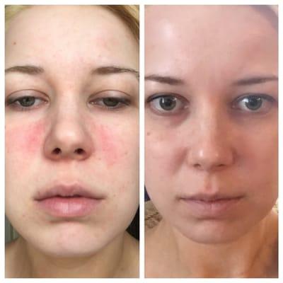 The oxygen facial to help with redness and dryness before and after taken in one hour difference. I'm obsessed! Go see Liz.