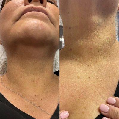 Before and after filler in neck laxity