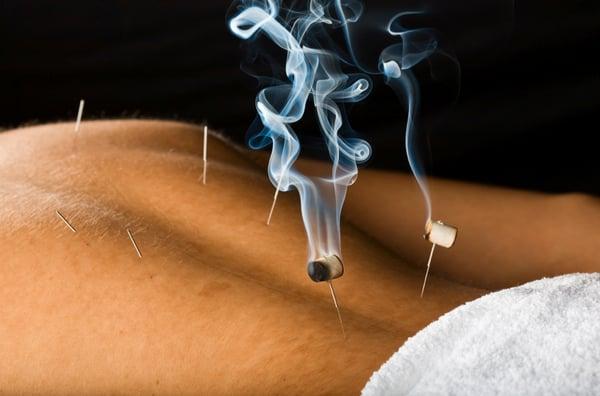 Acupuncture and Moxa Treatment