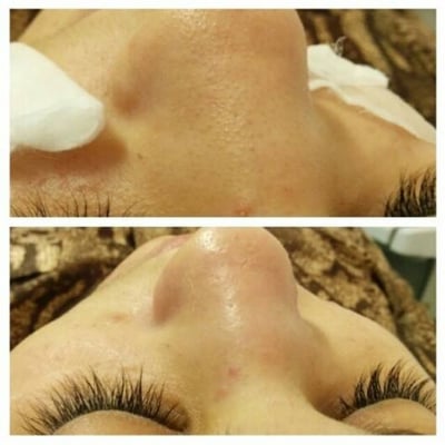 Before and after deep pore cleansing facial.